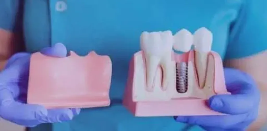 دليل شامل لزراعة الأسنان في مصر