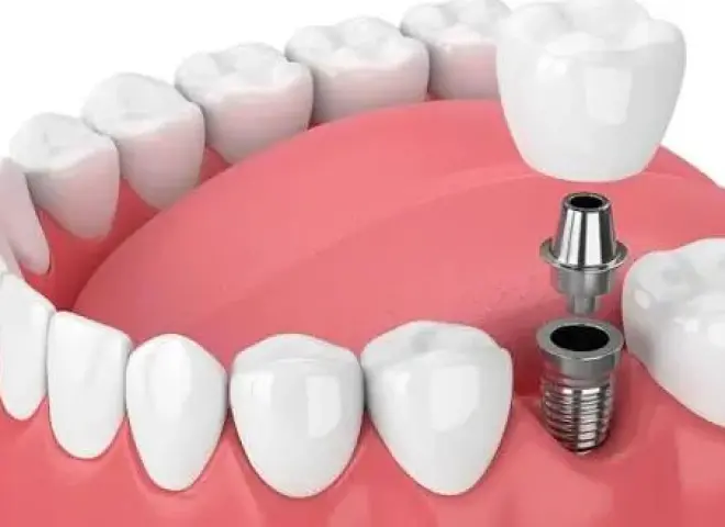 دليل جراحة وتجميل الأسنان في مصر: ارخص اسعار زراعة اسنان