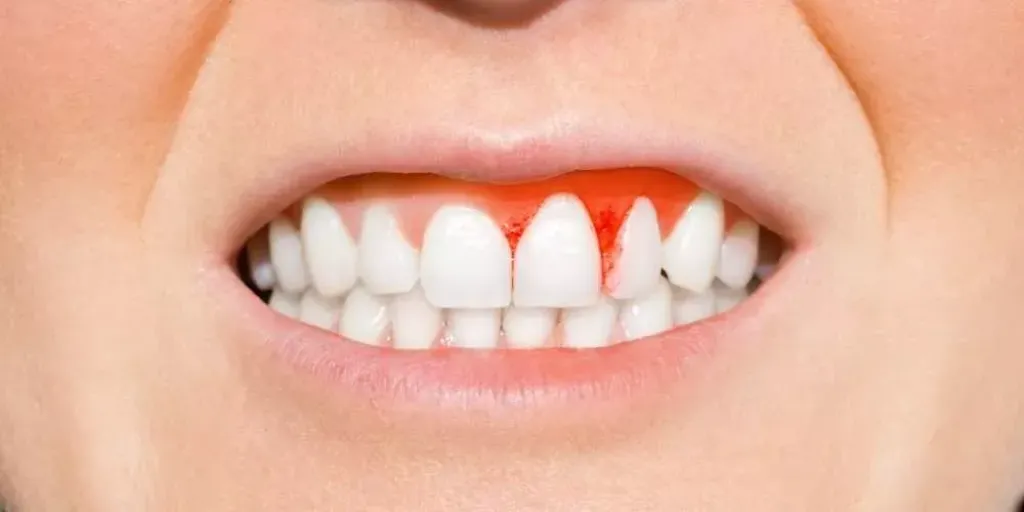 أسباب التهاب اللثة وطرق السيطرة عليها منزليا وطبيا