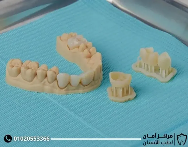 هل زراعة الاسنان مؤلمة؟ تعرف على أحدث التقنيات في زراعتها